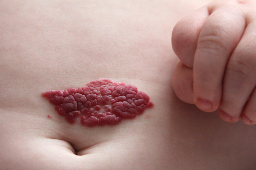 Hemangioma: What Is It and What Treatment Options Are Available in Dubai Hemangioma: What Is It and What Treatment Options Are Available in Dubai